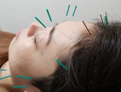鍼施術の様子