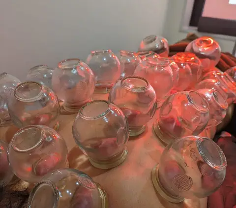 吸玉(カッピング)施術の様子
