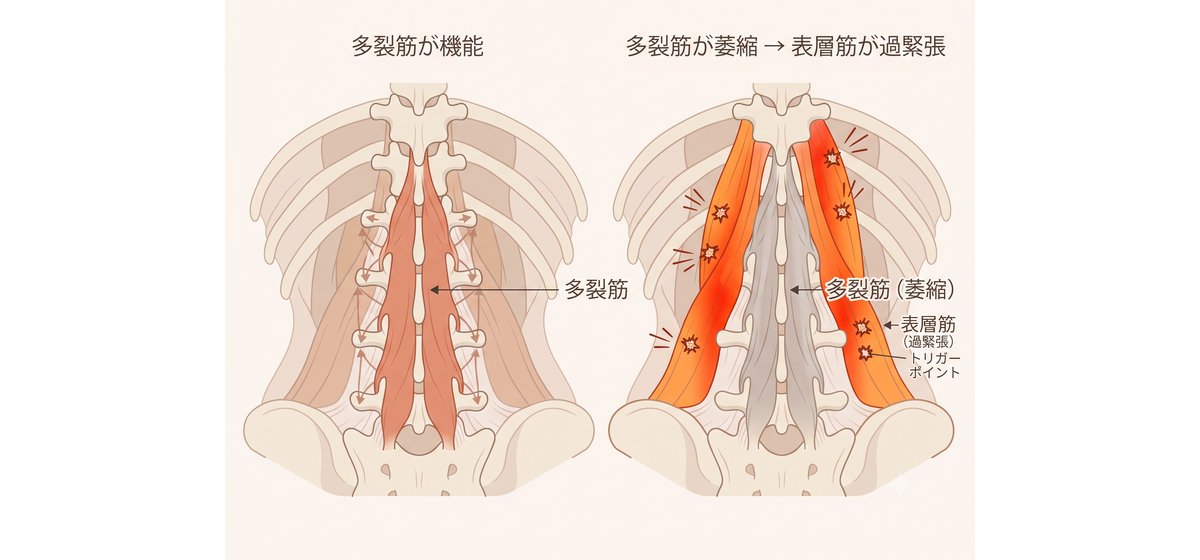 左：多裂筋が正常に機能している腰椎。右：多裂筋が萎縮し、表層筋が過緊張している状態