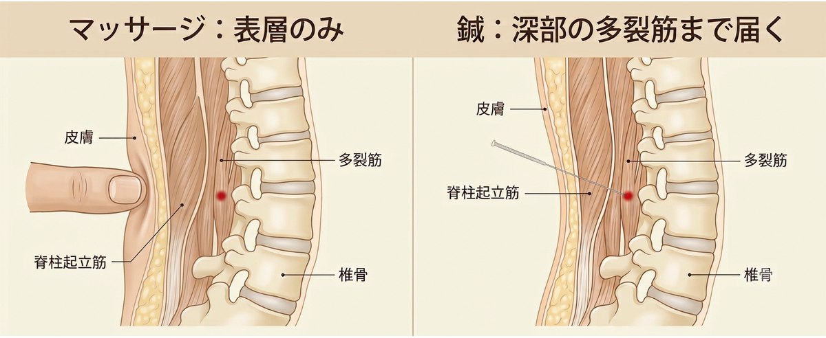 左：マッサージの圧は表層止まり。右：鍼は深部の多裂筋まで届く断面比較図