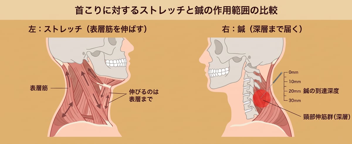 ストレッチと鍼の作用深度比較:深層筋には鍼が直接届く