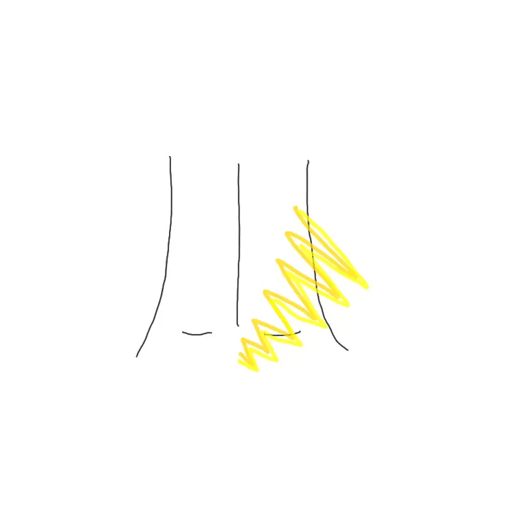 しびれ